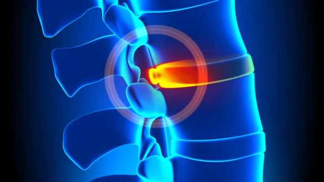 Spinal Disc Hernia and physical therapy